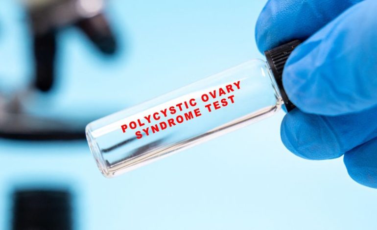 Le syndrome des ovaires polykystiques renommé : une nouvelle appellation pour une meilleure compréhension