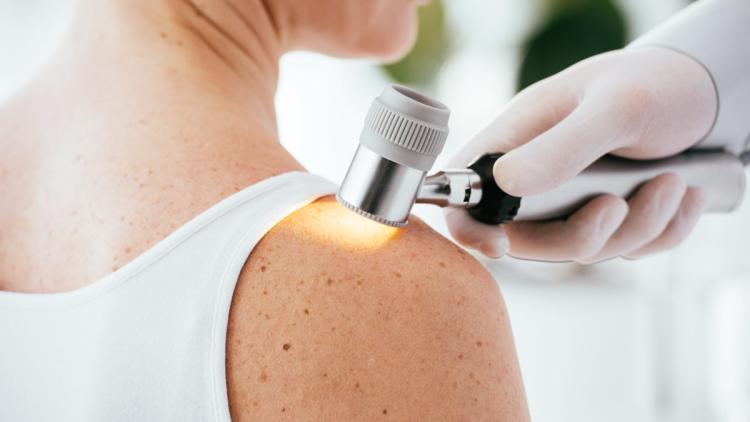 Une avancée dans la détection précoce des cancers de la peau
