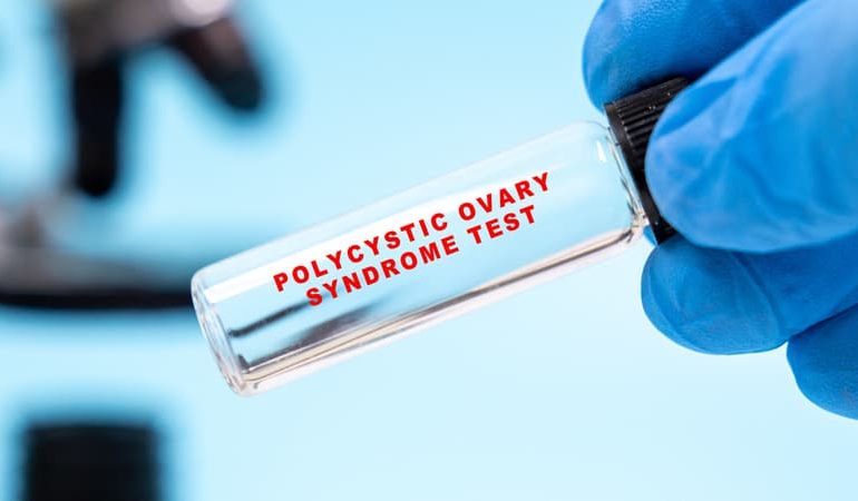 Renommé syndrome métabolique ovarien polyendocrinien