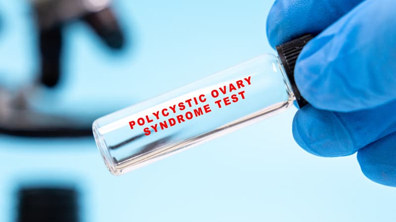Renommé syndrome métabolique ovarien polyendocrinien