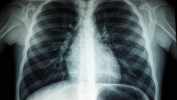 Le dépistage du cancer du poumon en France : Un programme prometteur