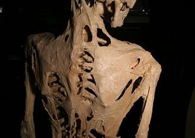 Comprendre la fibrodysplasie ossifiante progressive