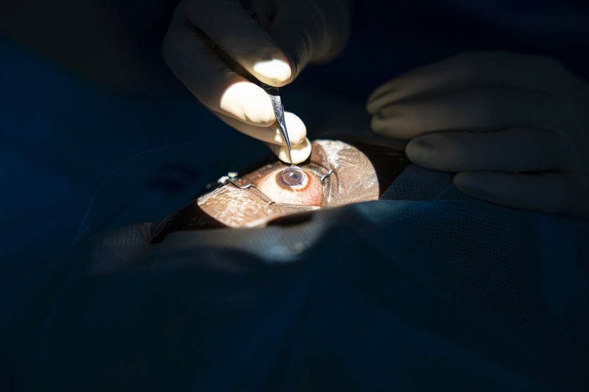 La greffe de cornée en France : Un espoir pour de nombreux patients