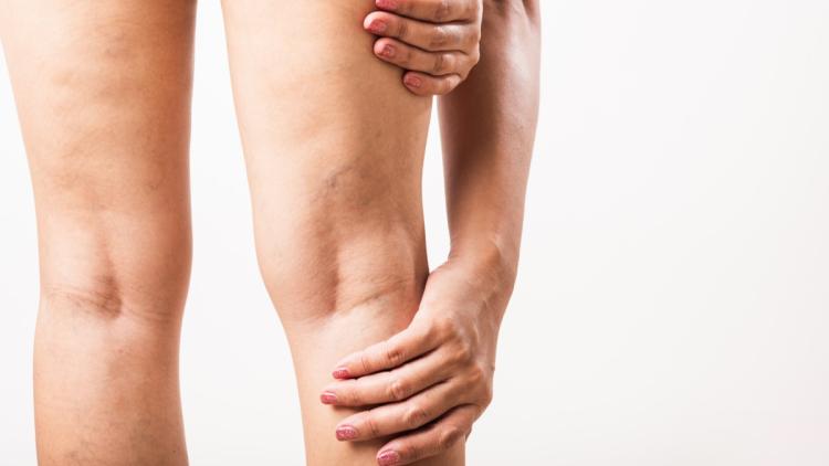 Comprendre les symptômes des varices