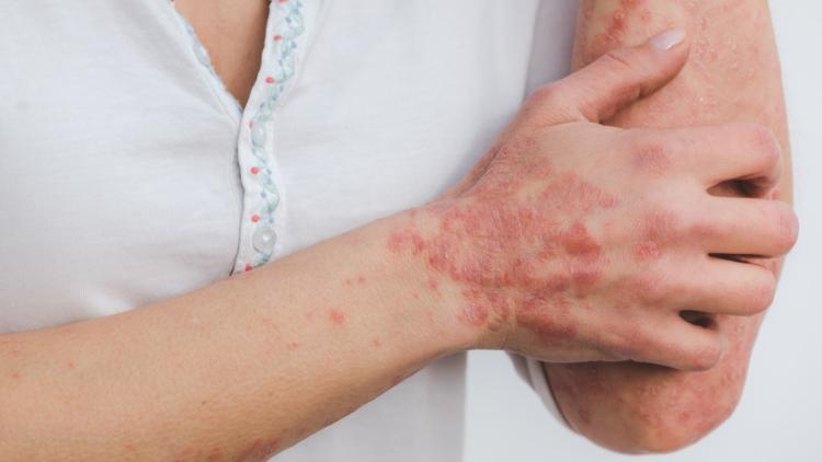 Une avancée génétique offre un nouvel espoir pour le psoriasis résistant
