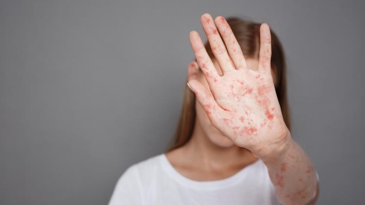 Augmentation des cas de rougeole et baisse de la vaccination aux États-Unis